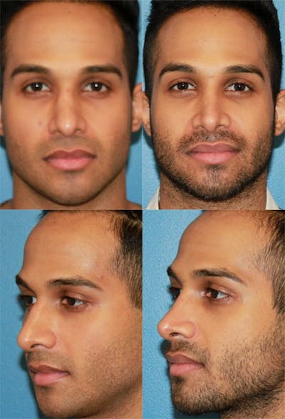 Male Rhinoplasty Before & After Gallery - Patient 2388290 - Image 1
