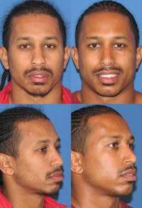 Male Rhinoplasty Before & After Gallery - Patient 2388291 - Image 1