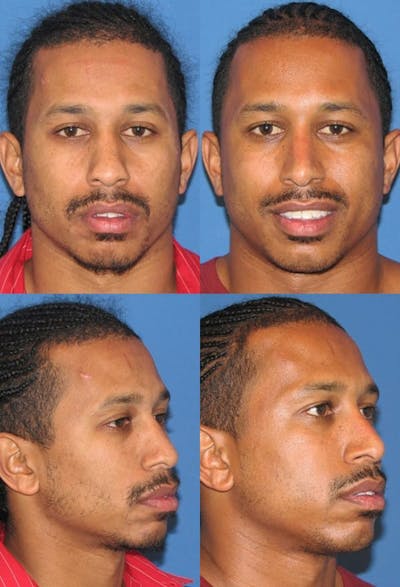 Male Rhinoplasty Before & After Gallery - Patient 2388291 - Image 1