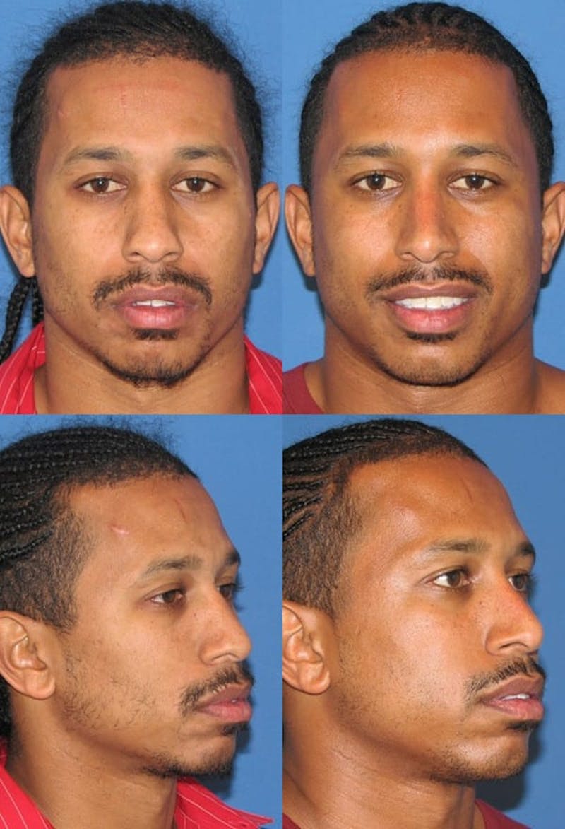 Male Rhinoplasty Before & After Gallery - Patient 2388291 - Image 1