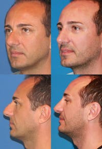 Male Rhinoplasty Before & After Gallery - Patient 2388292 - Image 1