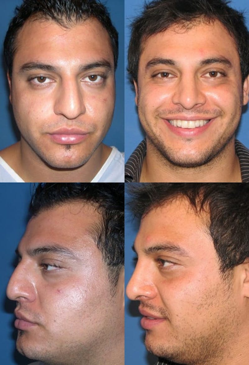 Male Rhinoplasty Before & After Gallery - Patient 2388293 - Image 1