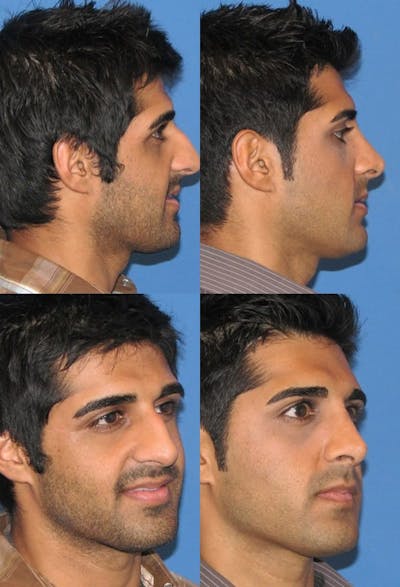 Rhinoplasty Before & After Gallery - Patient 2158494 - Image 1