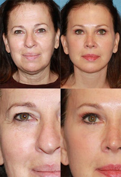 Eyelid Surgery (Blepharoplasty) Before & After Gallery - Patient 2158495 - Image 1