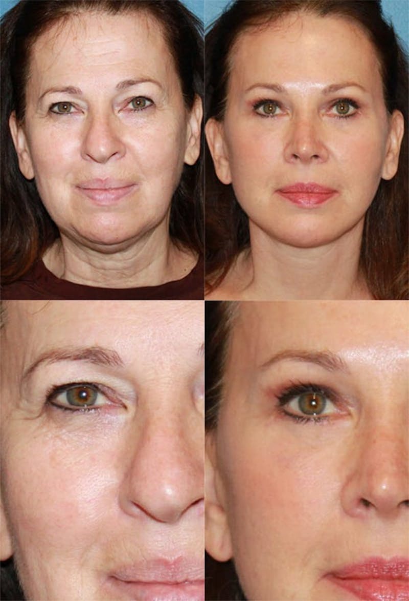 Upper Blepharoplasty Photo Gallery Before & After Gallery - Patient 2388317 - Image 1