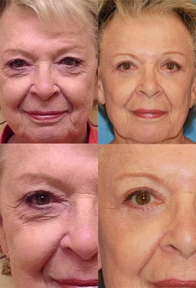 Upper Blepharoplasty Photo Gallery Before & After Gallery - Patient 2388318 - Image 1
