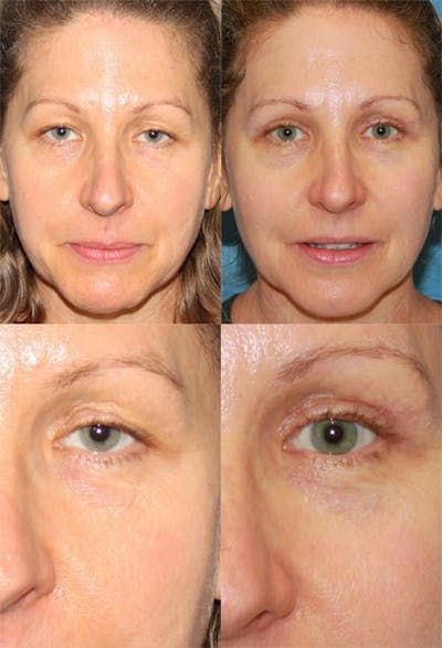 Upper Blepharoplasty Photo Gallery Before & After Gallery - Patient 2388319 - Image 1