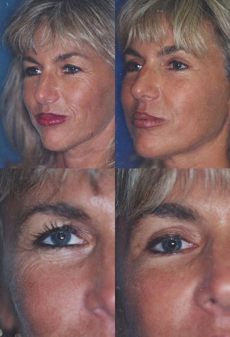 Upper Blepharoplasty Photo Gallery Before & After Gallery - Patient 2388320 - Image 1