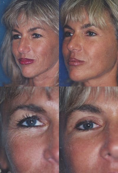 Upper Blepharoplasty Photo Gallery Before & After Gallery - Patient 2388320 - Image 1