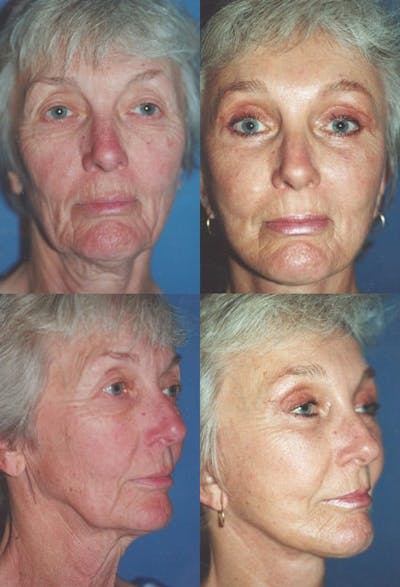 Upper Blepharoplasty Photo Gallery Before & After Gallery - Patient 2388324 - Image 1