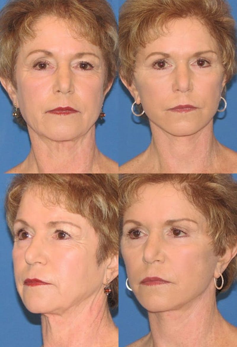 Upper Blepharoplasty Photo Gallery Before & After Gallery - Patient 2388325 - Image 1