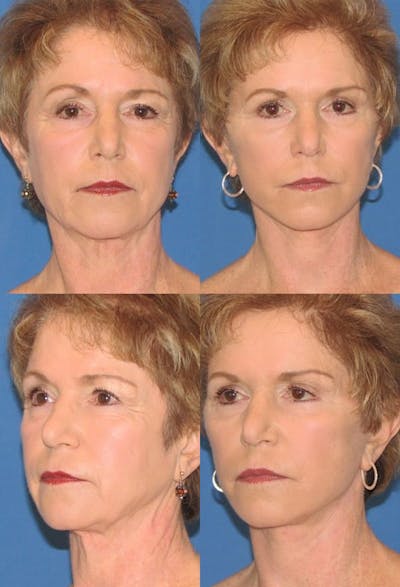 Eyelid Surgery (Blepharoplasty) Before & After Gallery - Patient 2158505 - Image 1