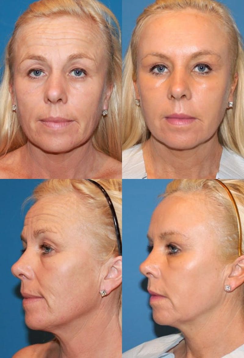 Upper Blepharoplasty Photo Gallery Before & After Gallery - Patient 2388326 - Image 1