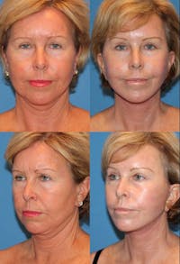 Upper Blepharoplasty Photo Gallery Before & After Gallery - Patient 2388327 - Image 1