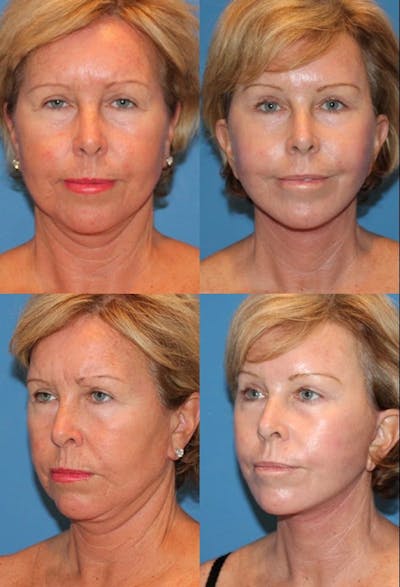 Eyelid Surgery (Blepharoplasty) Before & After Gallery - Patient 2158508 - Image 1