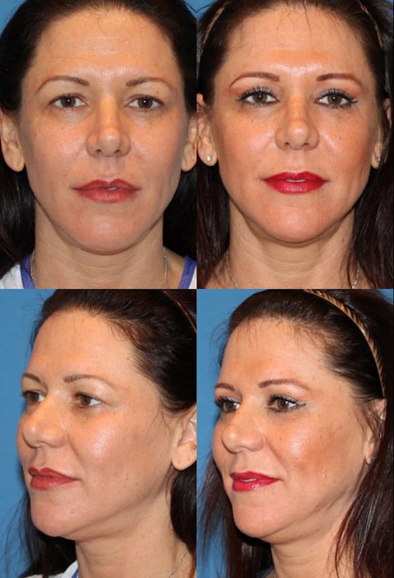 Eyelid Surgery (Blepharoplasty) Before & After Gallery - Patient 2158510 - Image 1