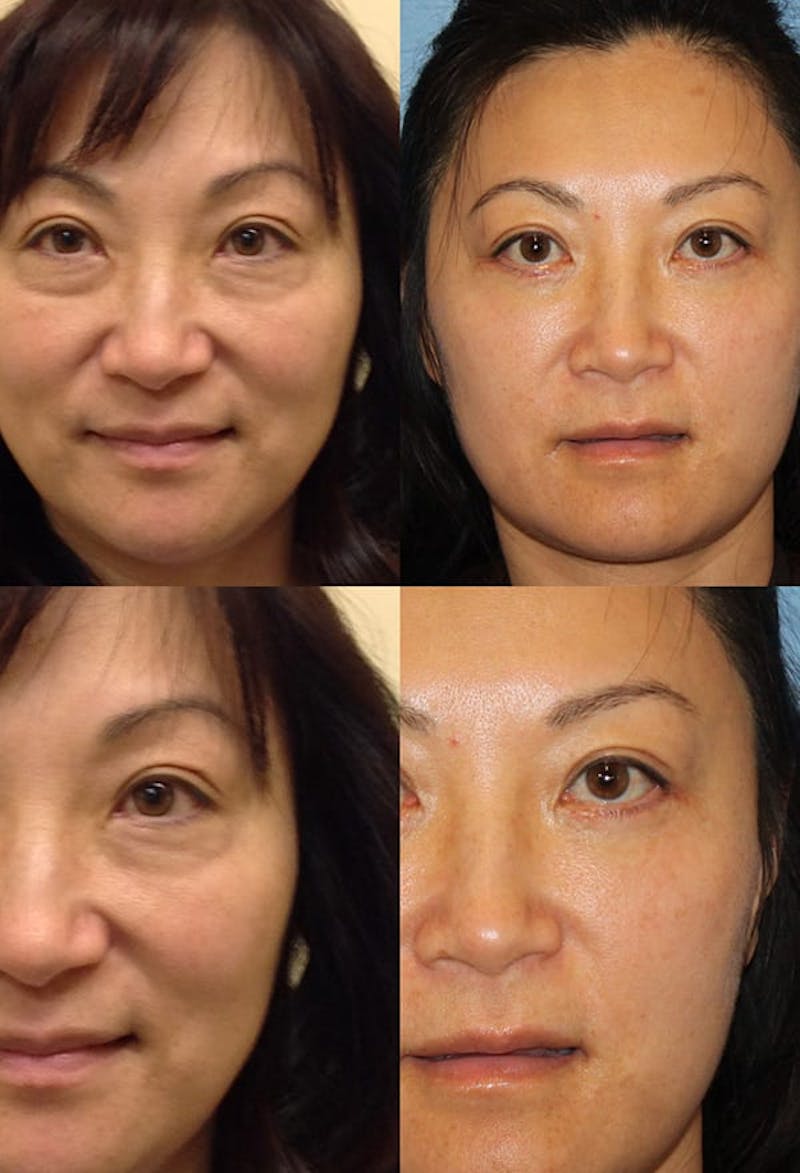 Eyelid Surgery (Blepharoplasty) Before & After Gallery - Patient 2158511 - Image 1