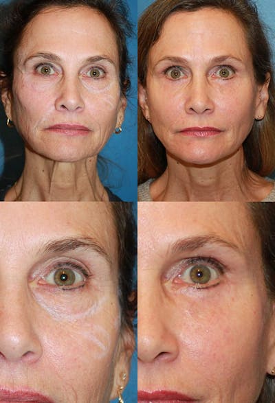 Lower Blepharoplasty Photo Gallery Before & After Gallery - Patient 2388451 - Image 1