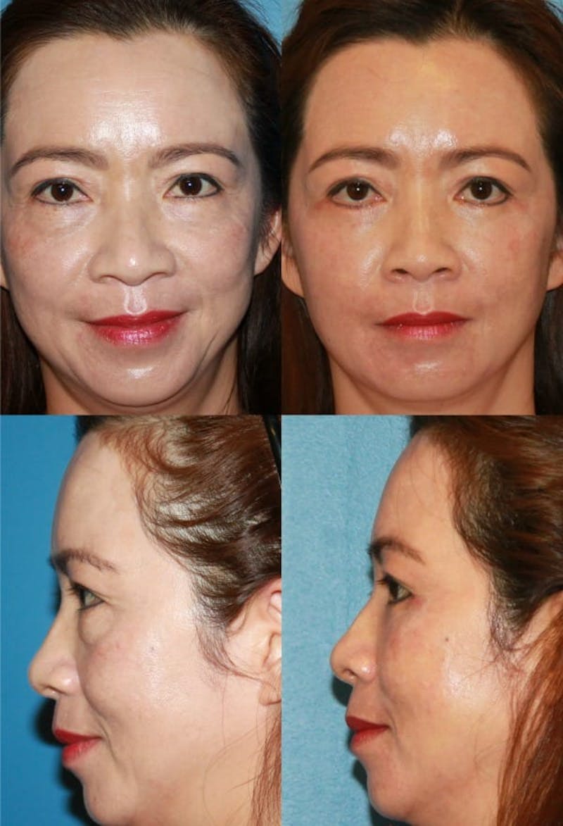 Lower Blepharoplasty Photo Gallery Before & After Gallery - Patient 2388452 - Image 1