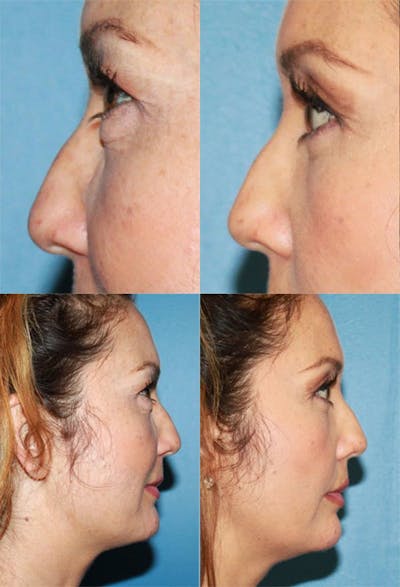 Eyelid Surgery (Blepharoplasty) Before & After Gallery - Patient 2158517 - Image 1