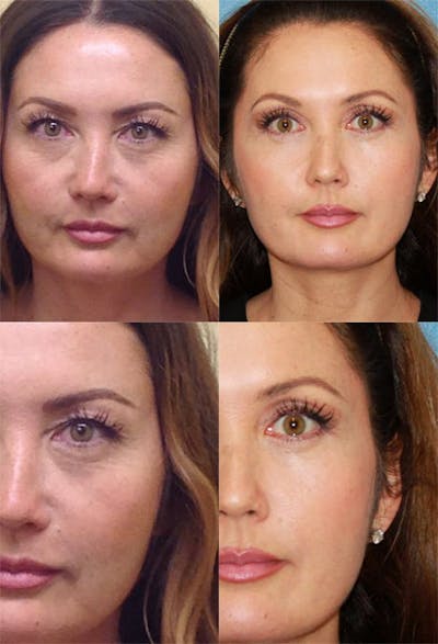 Eyelid Surgery (Blepharoplasty) Before & After Gallery - Patient 2158518 - Image 1
