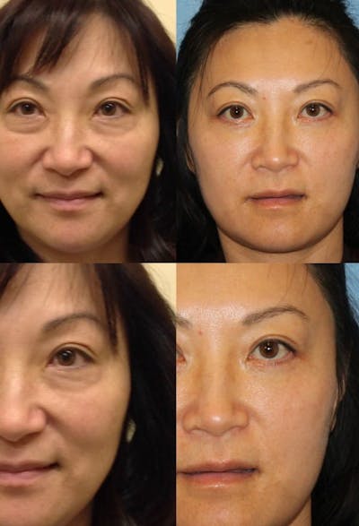 Eyelid Surgery (Blepharoplasty) Before & After Gallery - Patient 2158521 - Image 1