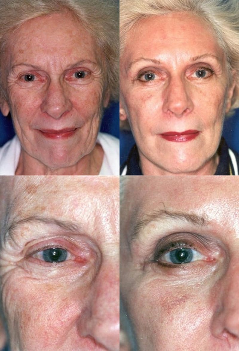 Lower Blepharoplasty Photo Gallery Before & After Gallery - Patient 2388457 - Image 1