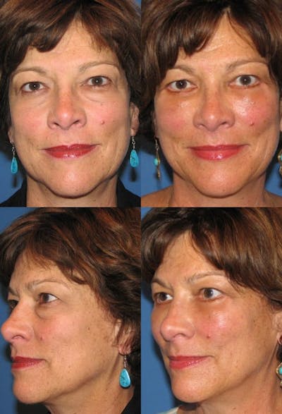 Lower Blepharoplasty Photo Gallery Before & After Gallery - Patient 2388458 - Image 1