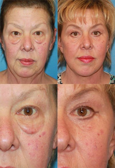 Eyelid Surgery (Blepharoplasty) Before & After Gallery - Patient 2158530 - Image 1