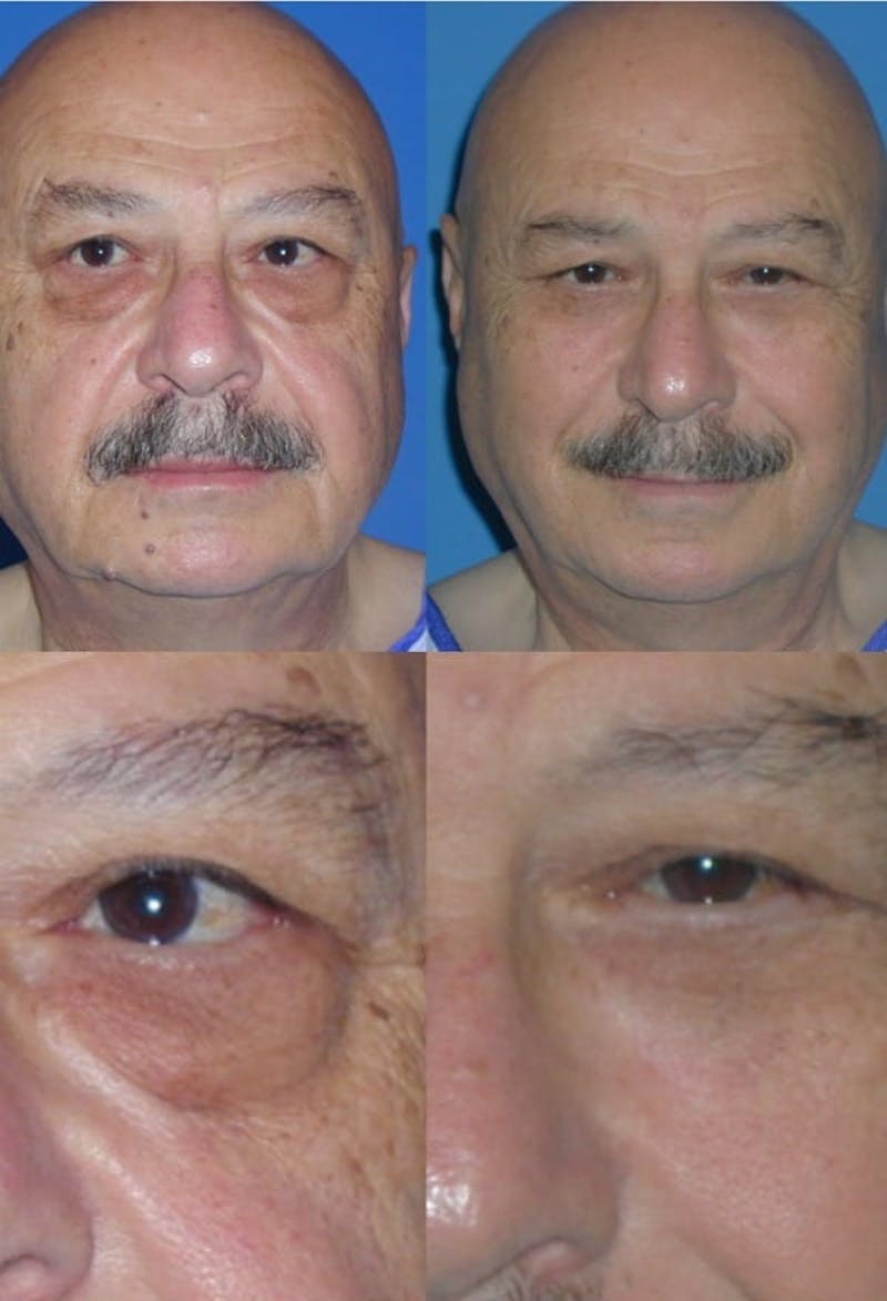 Lower Blepharoplasty Photo Gallery Before & After Gallery - Patient 2388460 - Image 1