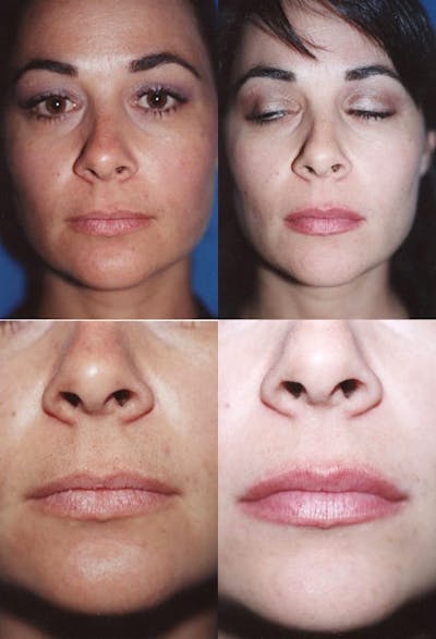 Lip Augmentation Before & After Gallery - Patient 2158533 - Image 1