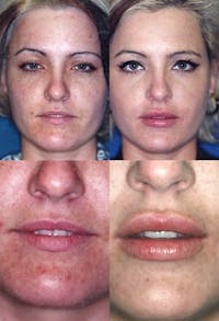 Lip Augmentation Before & After Gallery - Patient 2158536 - Image 1