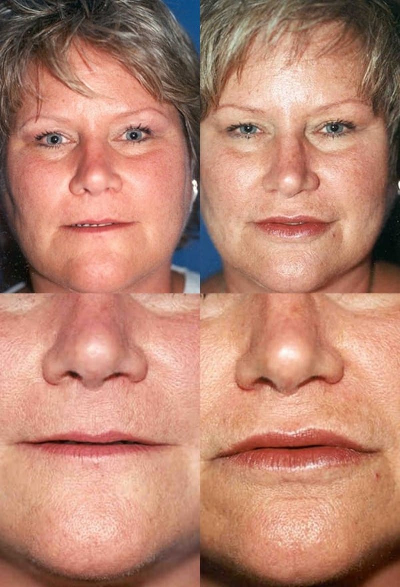 Lip Augmentation Before & After Gallery - Patient 2158537 - Image 1