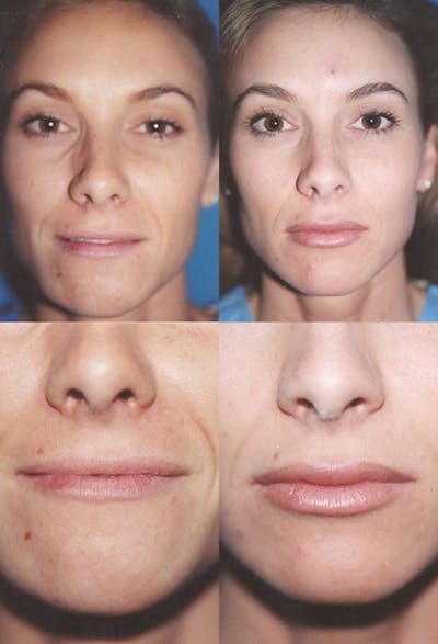 Lip Augmentation Before & After Gallery - Patient 2158538 - Image 1