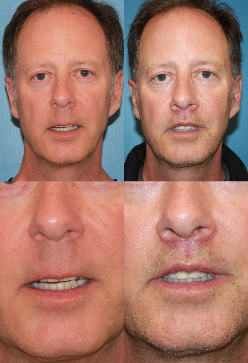 Lip Lift Before & After Gallery - Patient 2158564 - Image 1