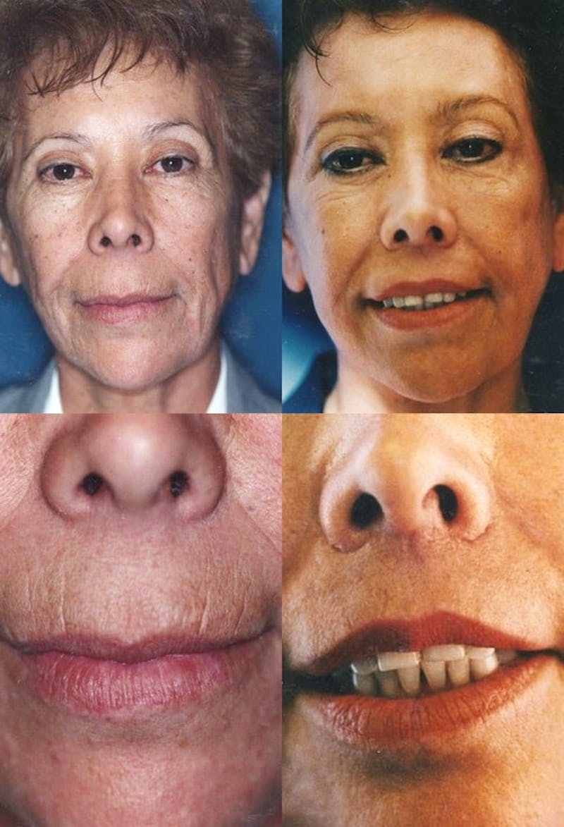 Lip Lift Before & After Gallery - Patient 2158565 - Image 1