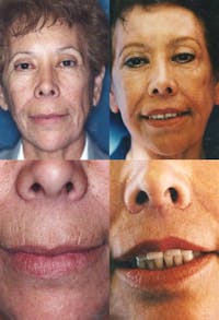 Lip Lift Before & After Gallery - Patient 2158565 - Image 1