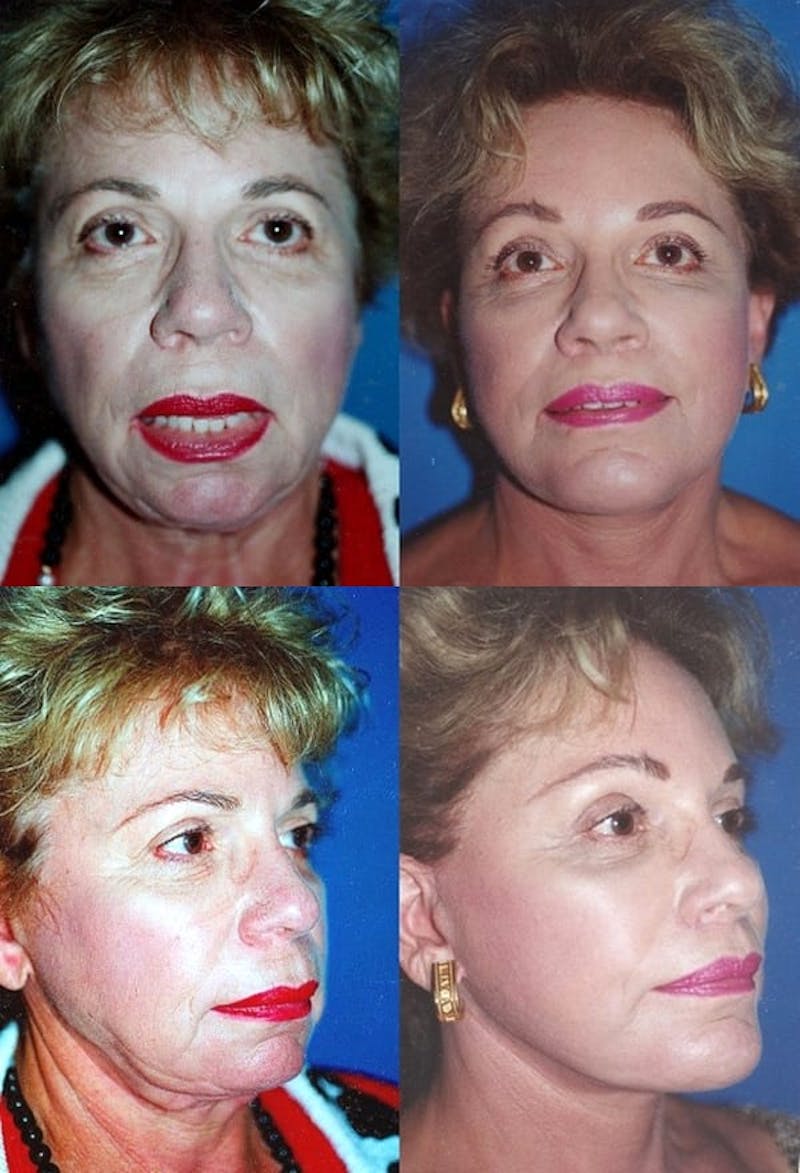 Lip Lift Before & After Gallery - Patient 2158567 - Image 1