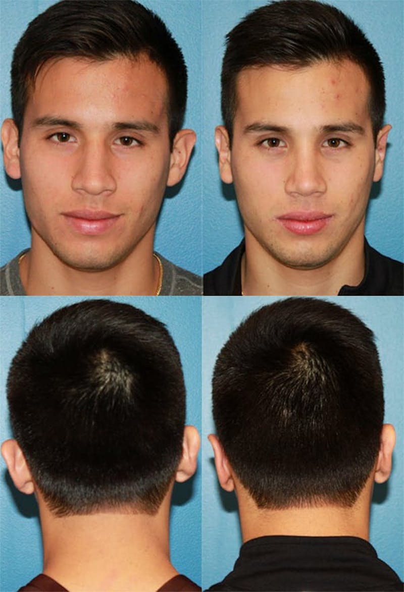 Dr. Chasan Otoplasty Before & After Gallery - Patient 2158573 - Image 1