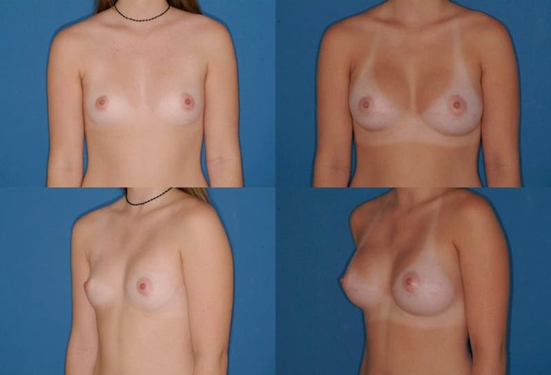 Large B Cup Augmentation Before & After Gallery - Patient 2387826 - Image 1