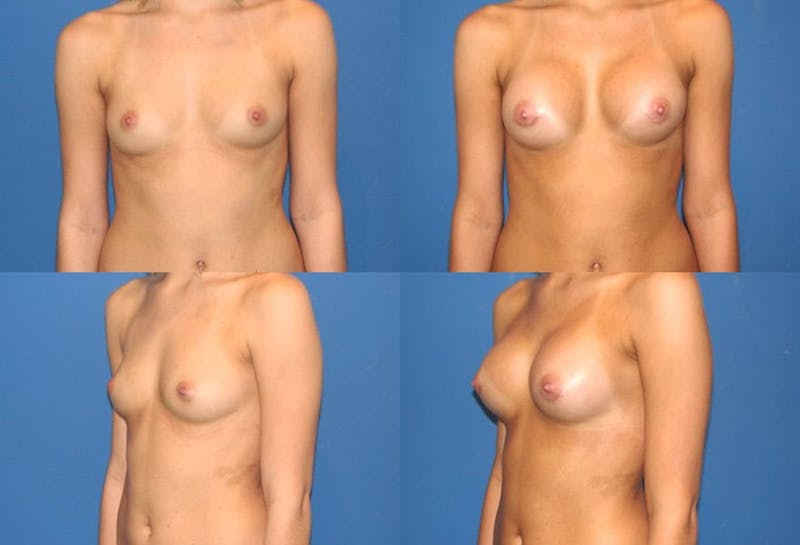 Large B Cup Augmentation Before & After Gallery - Patient 2387827 - Image 1