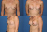 Large B Cup Augmentation Before & After Gallery - Patient 2387828 - Image 1