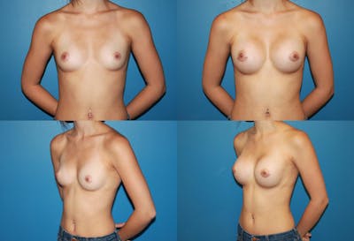 Small C Natural Shape Breast Before & After Gallery - Patient 2387846 - Image 1