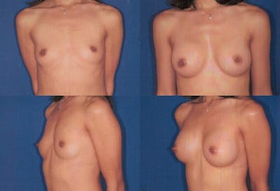 Small C Natural Shape Breast Before & After Gallery - Patient 2387847 - Image 1