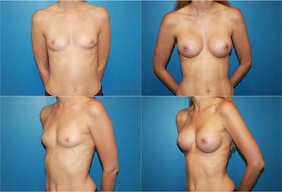 Small C Natural Shape Breast Before & After Gallery - Patient 2387848 - Image 1
