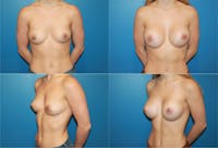 Small C Natural Shape Breast Before & After Gallery - Patient 2387849 - Image 1
