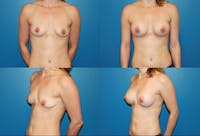 Small C Natural Shape Breast Before & After Gallery - Patient 2387850 - Image 1