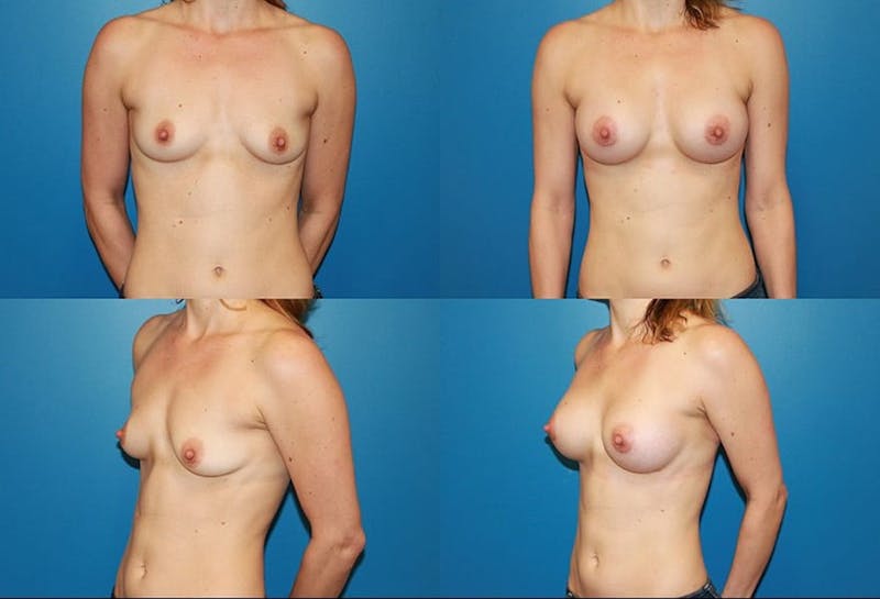 Breast Augmentation Before & After Gallery - Patient 2158595 - Image 1