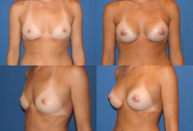 Small C Natural Shape Breast Before & After Gallery - Patient 2387851 - Image 1