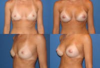 Breast Augmentation Before & After Gallery - Patient 2158598 - Image 1